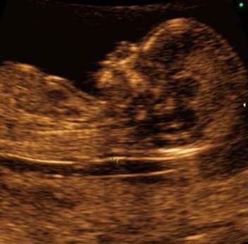 Hamilelik sırasında St. Petersburg'da ilk üç aylık döneminin taranması gereken yerler nerede?