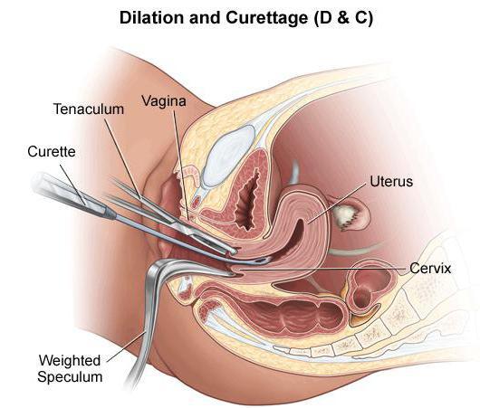 Yapay kürtaj: nedir? Endikasyonlar ve kontrendikasyonlar