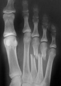 ayak metatarsal kemik kırığı