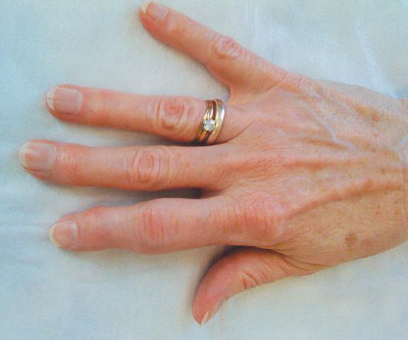 Parmağın eldeki şişmesi: nedenleri ve tedavi yöntemleri